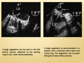 A large vegetation can be seen in the left
atrium (arrow), attached to the sewing
ring of a St. Jude mitral prosthesis.
A large vegetation is demonstrated in a
patient with a repaired mitral valve and
mitral ring. The vegetation can be seen
filling the mitral orifice (arrows)
 