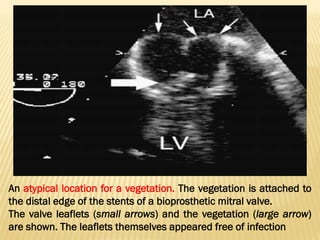 An atypical location for a vegetation. The vegetation is attached to
the distal edge of the stents of a bioprosthetic mitral valve.
The valve leaflets (small arrows) and the vegetation (large arrow)
are shown. The leaflets themselves appeared free of infection
 