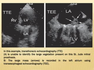 In this example, transthoracic echocardiography (TTE)
(A) is unable to identify the large vegetation present on this St. Jude mitral
prosthesis.
B: The large mass (arrows) is recorded in the left atrium using
transesophageal echocardiography (TEE).
 