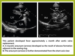 This patient developed fever approximately 1 month after aortic valve
replacement.
A: A mycotic aneurysm (arrows) developed as the result of abscess formation
adjacent to the sewing ring.
B:The aneurysm (arrows) is further demonstrated from the short-axis view
 