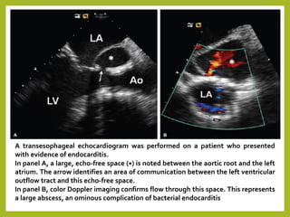 A transesophageal echocardiogram was performed on a patient who presented
with evidence of endocarditis.
In panel A, a large, echo-free space (∗) is noted between the aortic root and the left
atrium. The arrow identifies an area of communication between the left ventricular
outflow tract and this echo-free space.
In panel B, color Doppler imaging confirms flow through this space. This represents
a large abscess, an ominous complication of bacterial endocarditis
 