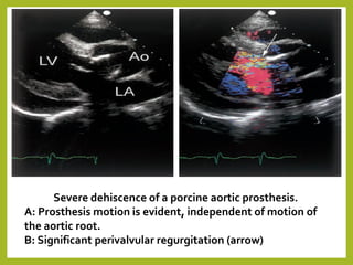 Severe dehiscence of a porcine aortic prosthesis.
A: Prosthesis motion is evident, independent of motion of
the aortic root.
B: Significant perivalvular regurgitation (arrow)
 