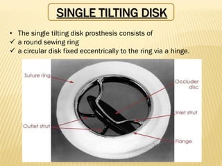 SINGLE TILTING DISK
• The single tilting disk prosthesis consists of
✓ a round sewing ring
✓ a circular disk fixed eccentrically to the ring via a hinge.
 