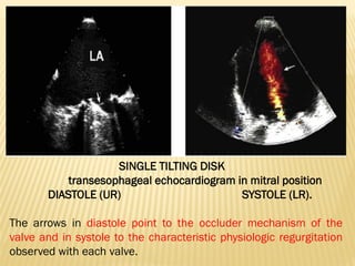 SINGLE TILTING DISK
transesophageal echocardiogram in mitral position
DIASTOLE (UR) SYSTOLE (LR).
The arrows in diastole point to the occluder mechanism of the
valve and in systole to the characteristic physiologic regurgitation
observed with each valve.
 