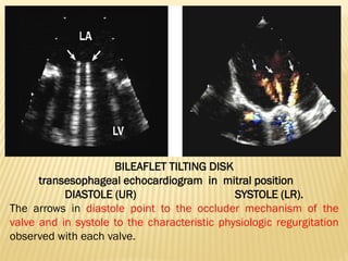 BILEAFLET TILTING DISK
transesophageal echocardiogram in mitral position
DIASTOLE (UR) SYSTOLE (LR).
The arrows in diastole point to the occluder mechanism of the
valve and in systole to the characteristic physiologic regurgitation
observed with each valve.
 