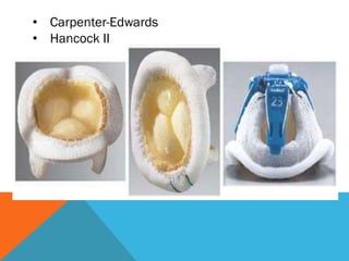 • Carpenter-Edwards
• Hancock II
 