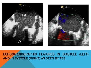 ECHOCARDIOGRAPHIC FEATURES IN DIASTOLE (LEFT)
AND IN SYSTOLE (RIGHT) AS SEEN BY TEE.
 