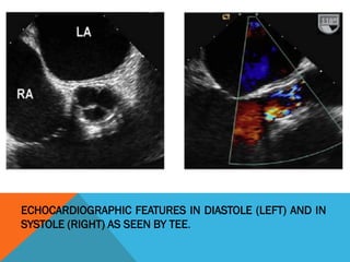 ECHOCARDIOGRAPHIC FEATURES IN DIASTOLE (LEFT) AND IN
SYSTOLE (RIGHT) AS SEEN BY TEE.
 