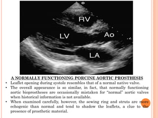 A NORMALLY FUNCTIONING PORCINE AORTIC PROSTHESIS
• Leaflet opening during systole resembles that of a normal native valve.
• The overall appearance is so similar, in fact, that normally functioning
aortic bioprostheses are occasionally mistaken for “normal” aortic valves
when historical information is not available.
• When examined carefully, however, the sewing ring and struts are more
echogenic than normal and tend to shadow the leaflets, a clue to the
presence of prosthetic material.
 