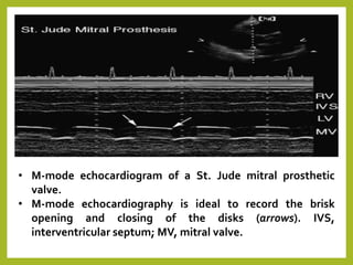 • M-mode echocardiogram of a St. Jude mitral prosthetic
valve.
• M-mode echocardiography is ideal to record the brisk
opening and closing of the disks (arrows). IVS,
interventricular septum; MV, mitral valve.
 