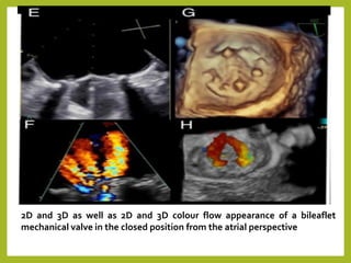 2D and 3D as well as 2D and 3D colour flow appearance of a bileaflet
mechanical valve in the closed position from the atrial perspective
 