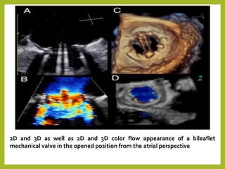 2D and 3D as well as 2D and 3D color flow appearance of a bileaflet
mechanical valve in the opened position from the atrial perspective
 
