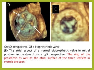 (D) 3D perspective. Of a bioprosthetic valve
(E) The atrial aspect of a normal bioprosthetic valve in mitral
position in diastole from a 3D perspective. The ring of the
prosthesis as well as the atrial surface of the three leaflets in
systole are seen.
 