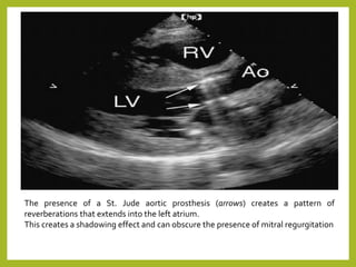 The presence of a St. Jude aortic prosthesis (arrows) creates a pattern of
reverberations that extends into the left atrium.
This creates a shadowing effect and can obscure the presence of mitral regurgitation
 
