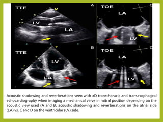 Acoustic shadowing and reverberations seen with 2D transthoracic and transesophageal
echocardiography when imaging a mechanical valve in mitral position depending on the
acoustic view used (A and B, acoustic shadowing and reverberations on the atrial side
(LA) vs. C and D on the ventricular (LV) side.
 