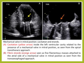 Mechanical valve in mitral position: cavitation and strands.
(A) Cavitation (yellow arrow) inside the left ventricular cavity related to the
presence of a mechanical valve in mitral position, as seen from the apical
transthoracic approach.
(B) Fibrin strands (orange arrow) seen as fine filamentous masses attached to
the atrial side of a mechanical valve in mitral position as seen from the
transoesophageal approach.
 