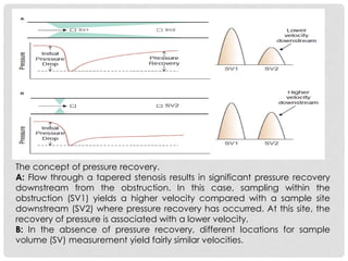 The concept of pressure recovery.
A: Flow through a tapered stenosis results in significant pressure recovery
downstream from the obstruction. In this case, sampling within the
obstruction (SV1) yields a higher velocity compared with a sample site
downstream (SV2) where pressure recovery has occurred. At this site, the
recovery of pressure is associated with a lower velocity.
B: In the absence of pressure recovery, different locations for sample
volume (SV) measurement yield fairly similar velocities.
 