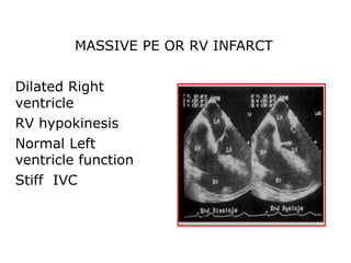 Preload Effected Rv Infarct Echocardiography in ER 2020 | PPT