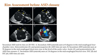 Ase Asd Rims Echocardiography in intervention cardiology | PPTX