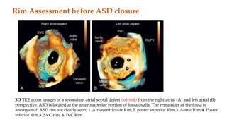 Echocardiography in intervention cardiology | PPTX