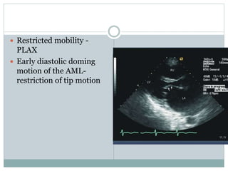  Restricted mobility -
PLAX
 Early diastolic doming
motion of the AML-
restriction of tip motion
 