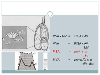 MVA x MV = PISA x AV
MVA = PISA x AV
MV
PISA = 2pr2 x a
180
MVA = 2pr2 x AV x a
MV 180
 