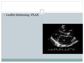  Leaflet thickening -PLAX
 