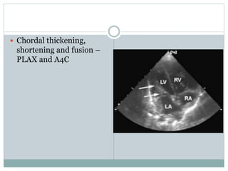  Chordal thickening,
shortening and fusion –
PLAX and A4C
 