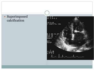  Superimposed
calcification
 