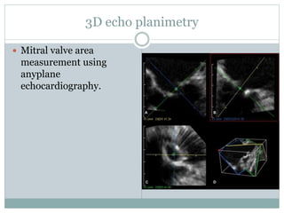 3D echo planimetry
 Mitral valve area
measurement using
anyplane
echocardiography.
 
