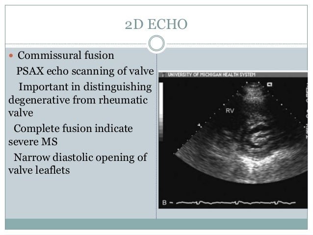 Echocardiography in mitral_stenosis