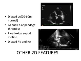 OTHER 2D FEATURES
• Dilated LA(20-60ml
normal)
• LA and LA appendage
thrombus
• Paradoxical septal
motion
• Dilated RV and RA
 