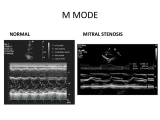 M MODE
NORMAL MITRAL STENOSIS
 