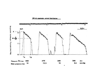 AF avoid short cycles and Average
different cardiac cycles
 