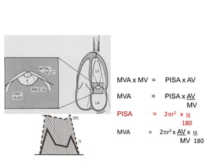 MVA x MV = PISA x AV
MVA = PISA x AV
MV
PISA = 2pr2 x a
180
MVA = 2pr2 x AV x a
MV 180
 