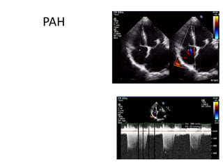 PAH
 