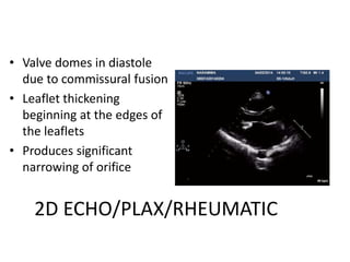 2D ECHO/PLAX/RHEUMATIC
• Valve domes in diastole
due to commissural fusion
• Leaflet thickening
beginning at the edges of
the leaflets
• Produces significant
narrowing of orifice
 