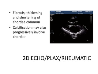2D ECHO/PLAX/RHEUMATIC
• Fibrosis, thickening
and shortening of
chordae common
• Calcification may also
progressively involve
chordae
 