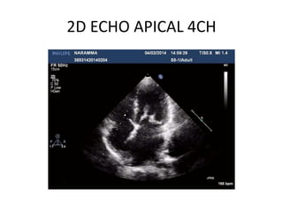 2D ECHO APICAL 4CH
 