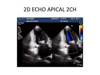 2D ECHO APICAL 2CH
 