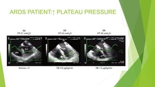 Echocardiography in res failure | PPT