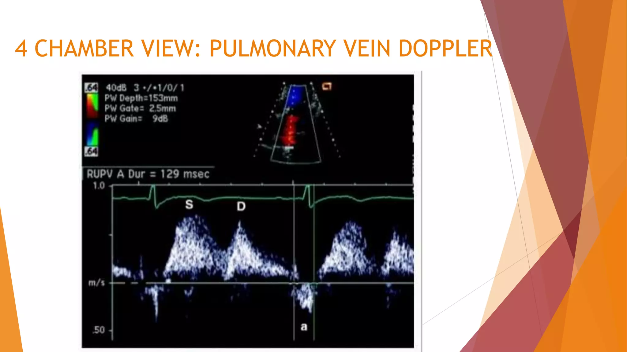 4 CHAMBER VIEW: PULMONARY VEIN DOPPLER