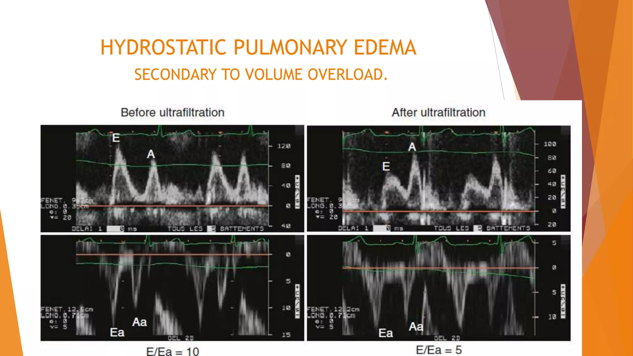 HYDROSTATIC PULMONARY EDEMA
SECONDARY TO VOLUME OVERLOAD.