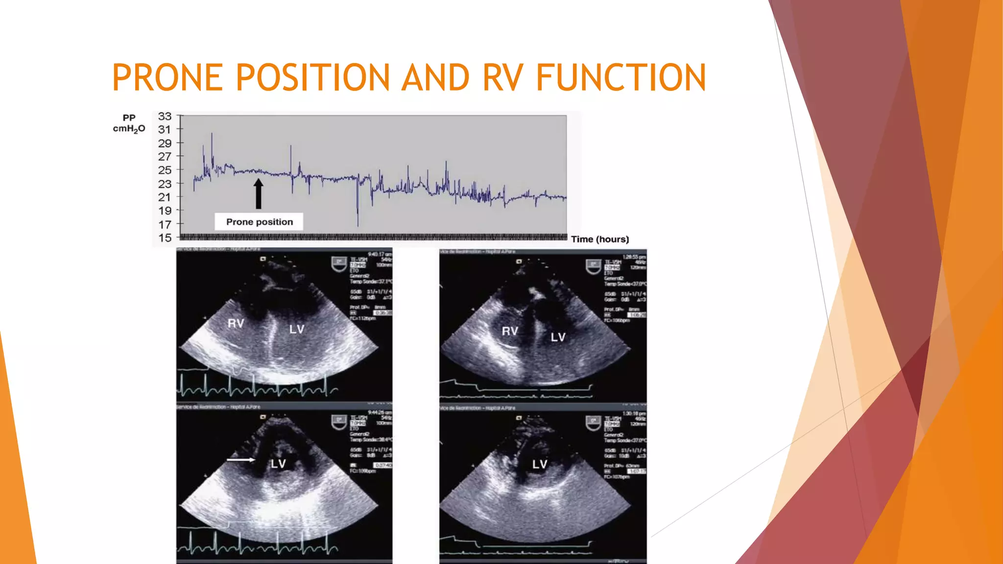 PRONE POSITION AND RV FUNCTION