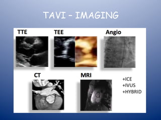 TAVI – IMAGING 
+ICE 
+IVUS 
+HYBRID 
 
