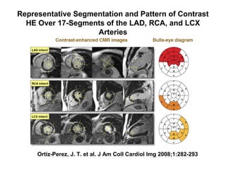 Representative Segmentation and Pattern of Contrast
HE Over 17-Segments of the LAD, RCA, and LCX
Arteries
Ortiz-Perez, J. T. et al. J Am Coll Cardiol Img 2008;1:282-293
 