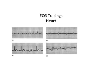 ECG Tracings
Heart
 