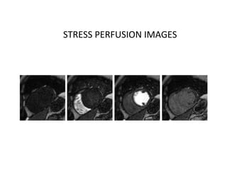 STRESS PERFUSION IMAGES
 