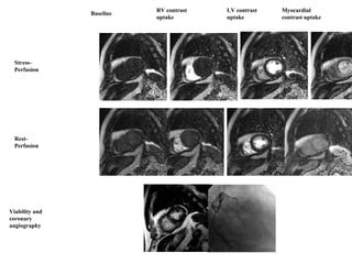 Stress-
Perfusion
Rest-
Perfusion
Baseline
LV contrast
uptake
RV contrast
uptake
Myocardial
contrast uptake
Viability and
coronary
angiography
 