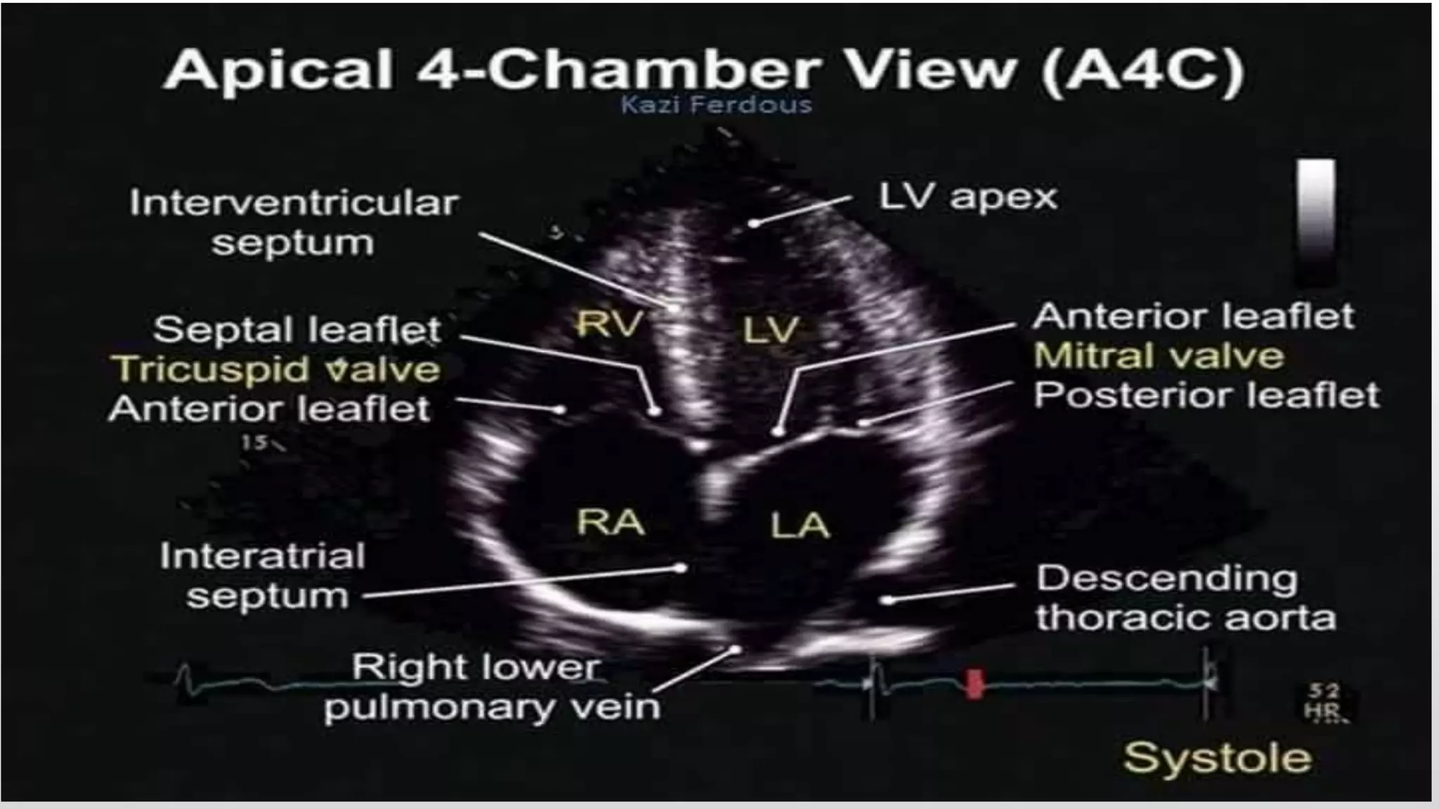 Echocardiography | PPTX